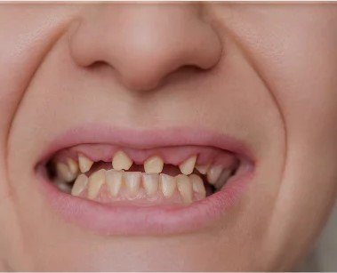 Smile-Restored-Dental-Implants-Before-and-After