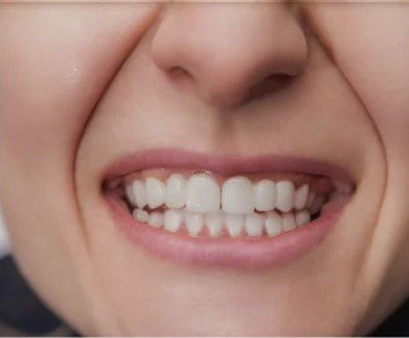 teeth-after