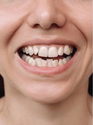 teeth-before